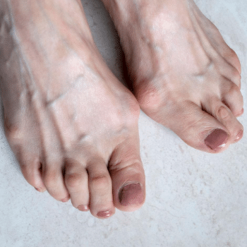 Hallux Valgus - vybočený palec na nohe